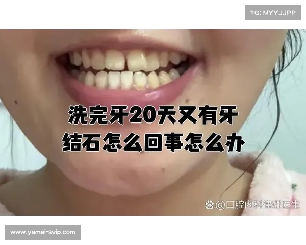 “很少刷牙,绝不洗牙”——网友为何对洗牙抱有怀疑态度? “很少刷牙,绝不洗牙”——网友为何对洗牙抱有怀疑态度?